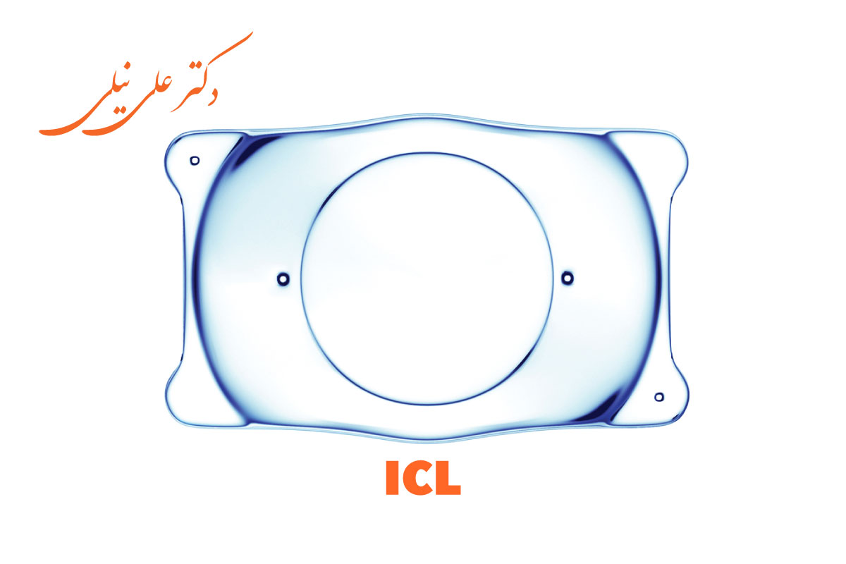 کاشت لنز داخل چشمی ICL