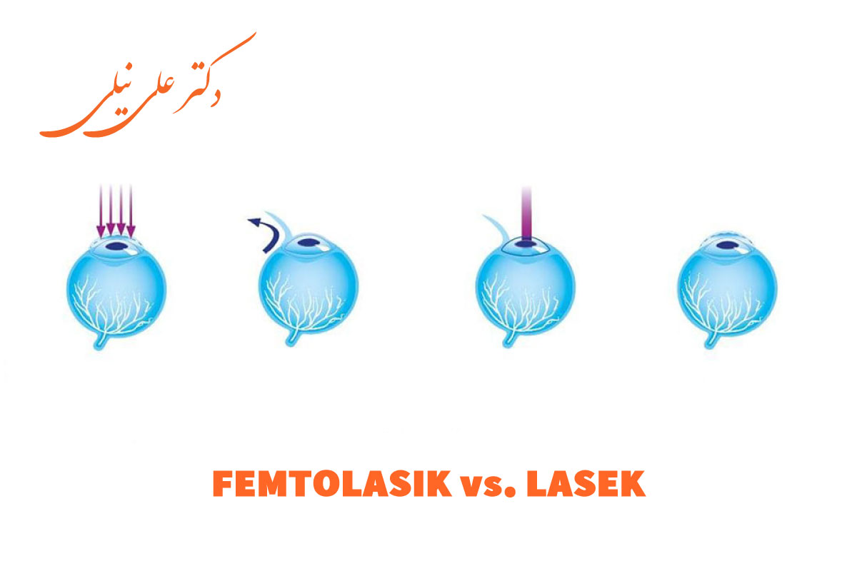 فمتولیزیک یا لازک؟