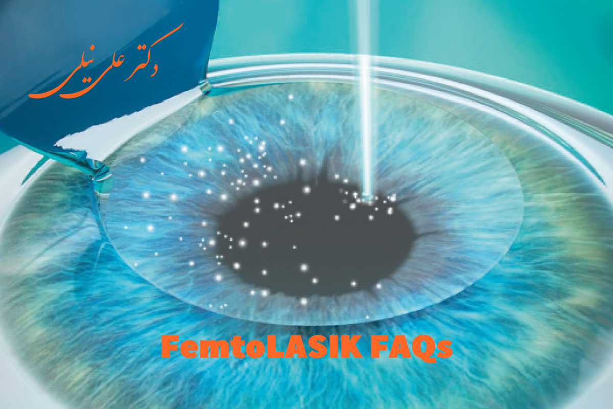 پرسش های رایج درباره عمل فمتولیزیک چشم