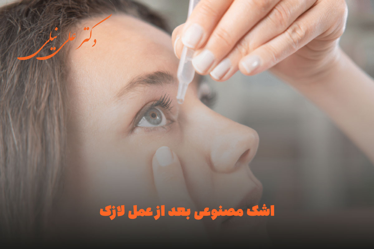 مدت زمان استفاده از اشک مصنوعی بعد از عمل لازک