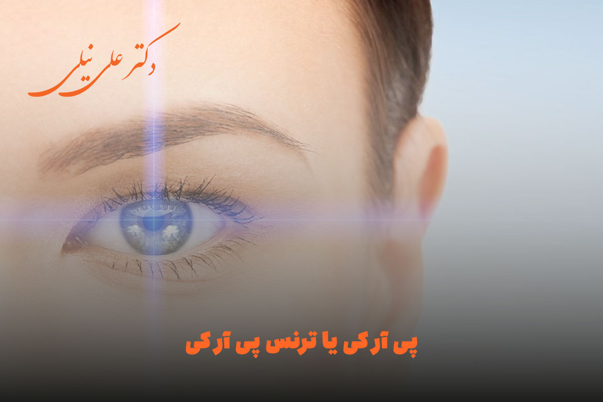 PRK یا TransPRK