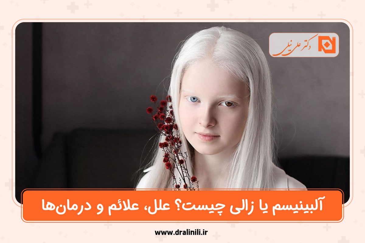 آلبینیسم یا زالی چیست؟
