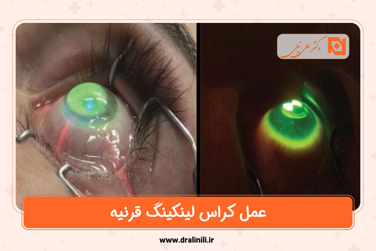 عمل کراس لینکینگ قرنیه