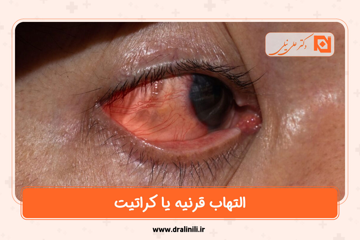 التهاب قرنیه یا کراتیت