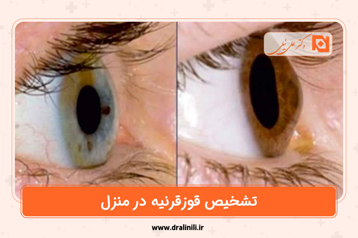 تشخیص قوزقرنیه در منزل