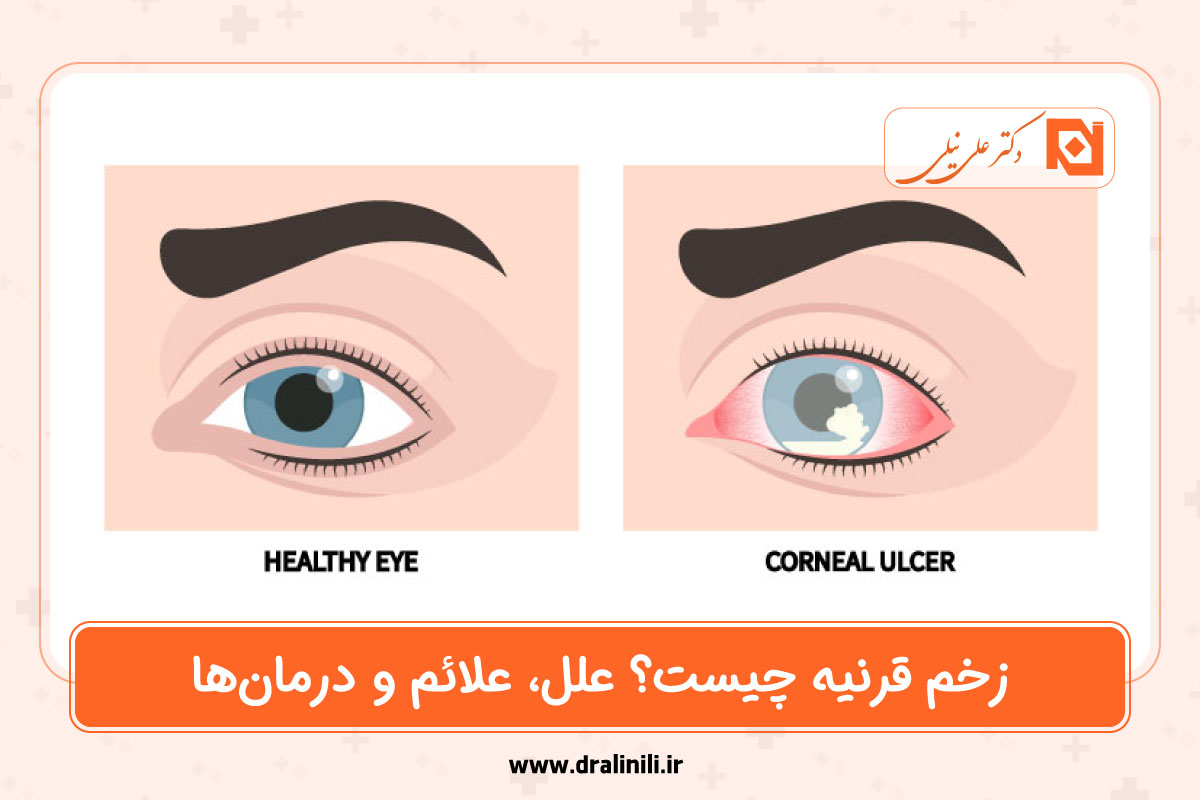 زخم قرنیه چیست