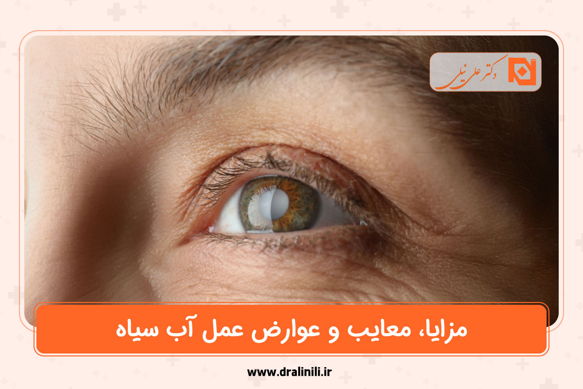 مزایا، معایب و عوارض عمل آب سیاه