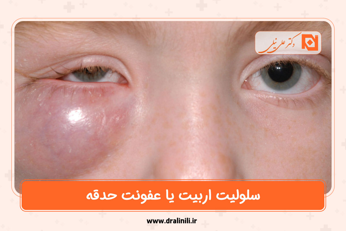 سلولیت اربیت