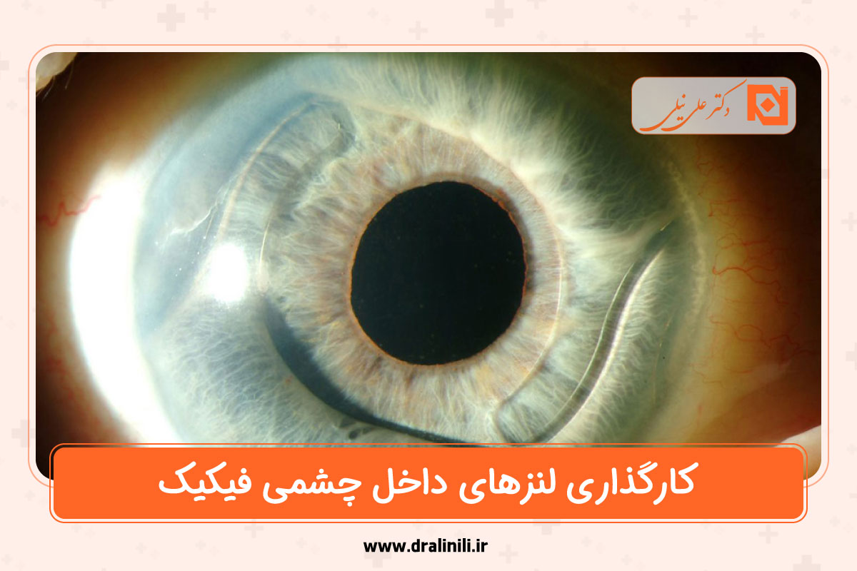 لنز داخل چشمی فیکیک